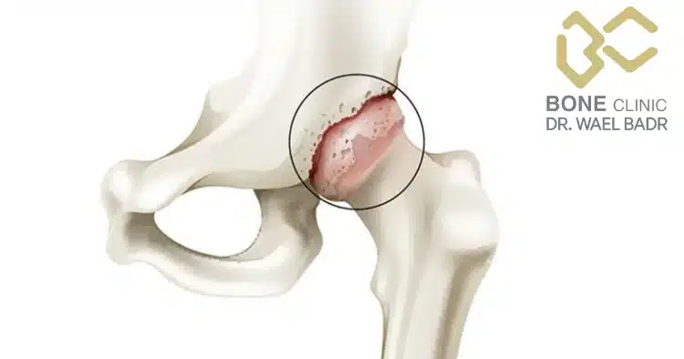 ما هي أسباب احتكاك مفصل الورك؟