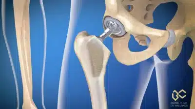 علاج شرخ الحوض لكبار السن