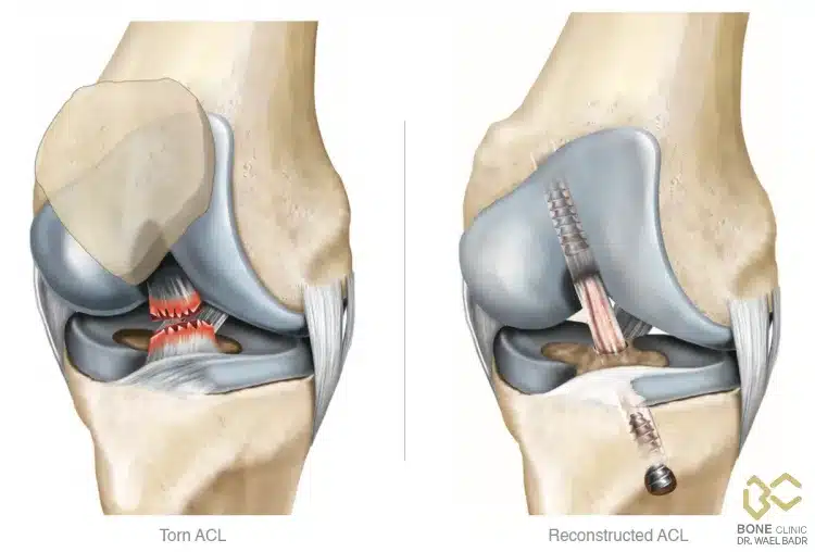 ما هو الرباط الصليبي؟ وما هي إصاباته؟