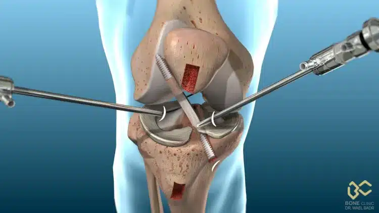 الفرق بين منظار الركبة وفتح الركبة الجراحي: أيهما أفضل؟