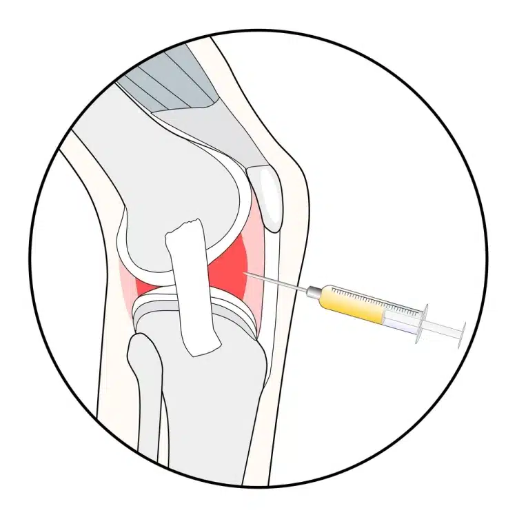 أضرار حقن خشونة الركبة