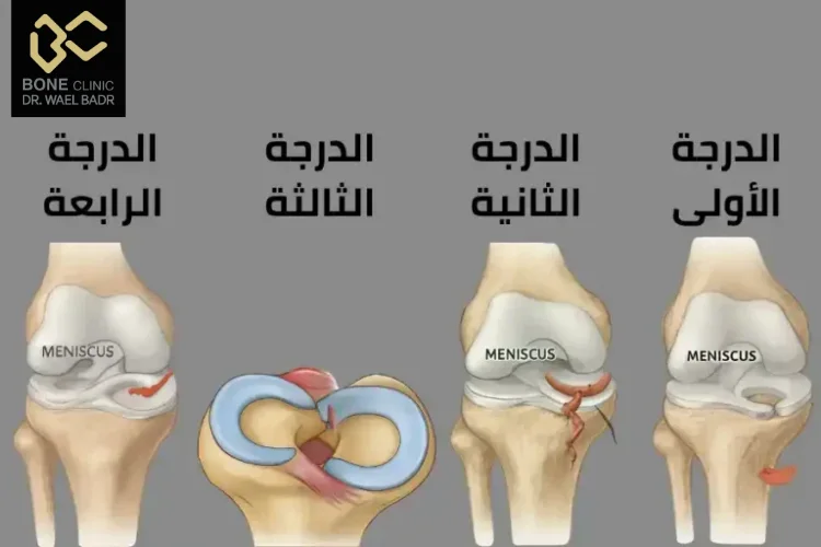 درجات تمزق الغضروف الهلالي