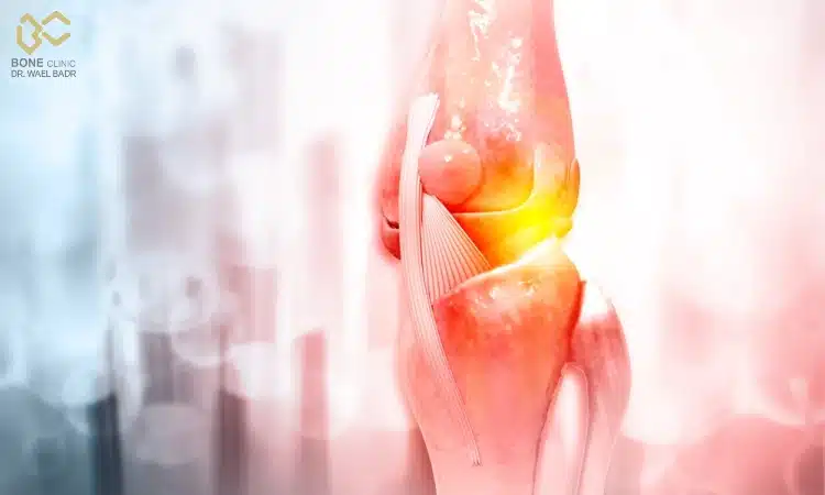 علاج تمزق الاربطة في الركبة