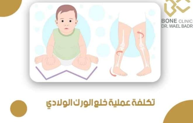 تكلفة عملية خلع الورك الولادي