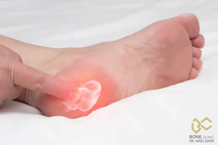 علاج الشوكه العظميه