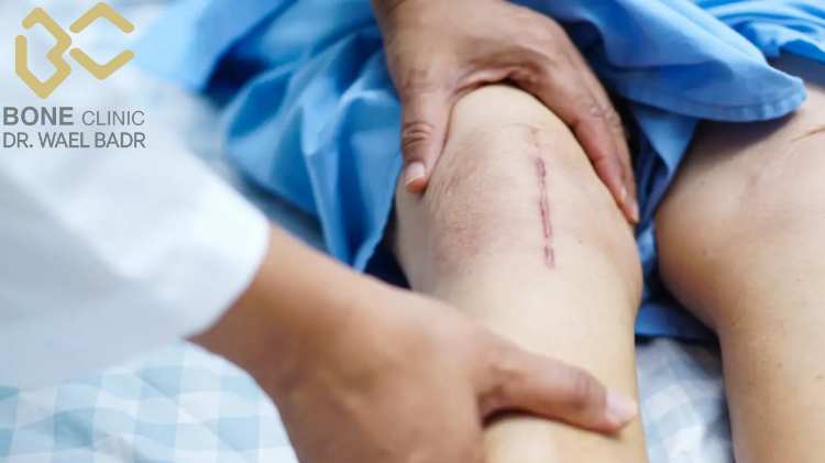 مدة الالتئام بعد ترقيع العظام