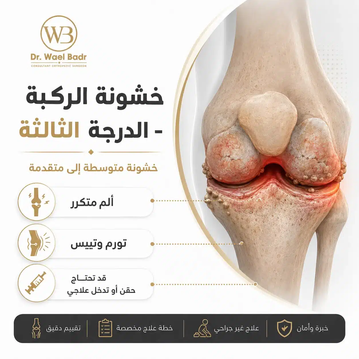 خشونة الركبة من الدرجة الثالثة