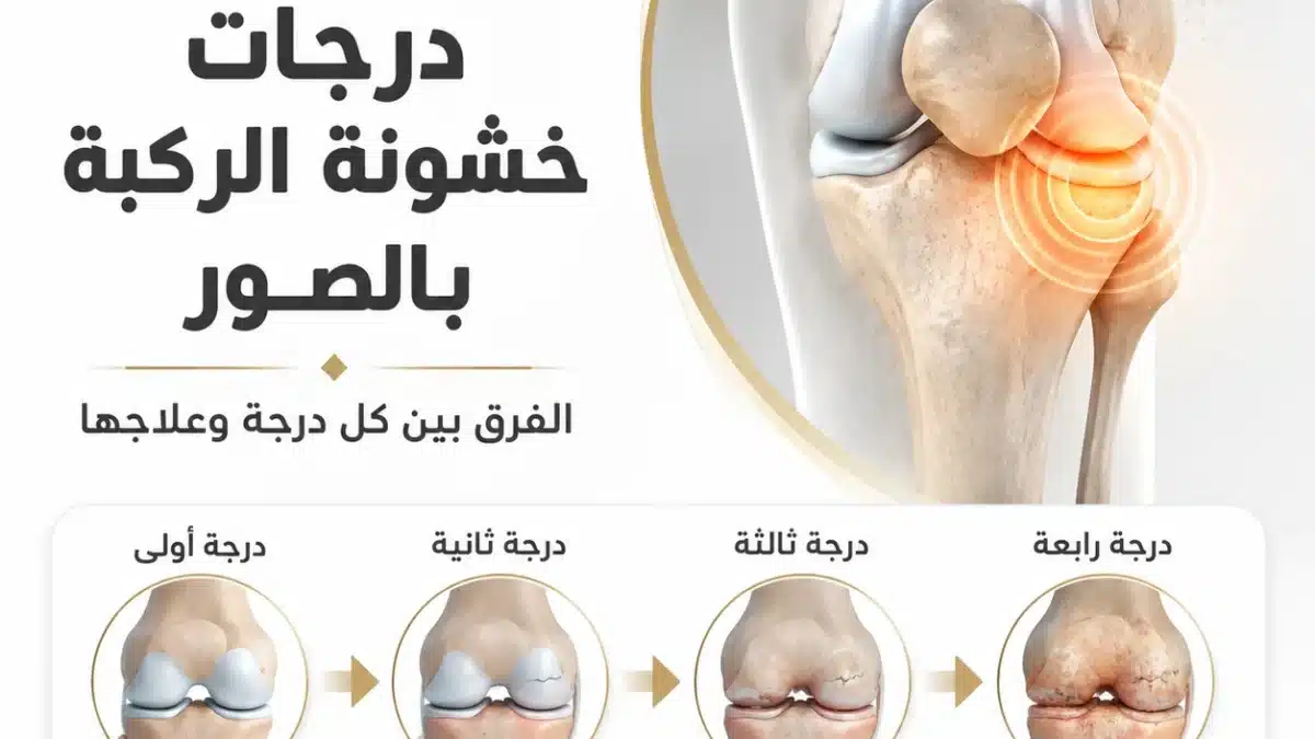 درجات خشونة الركبة بالصور