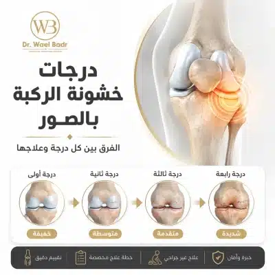 درجات خشونة الركبة بالصور