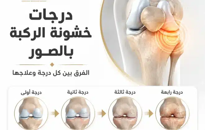 درجات خشونة الركبة بالصور
